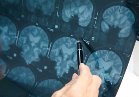 brain-injuries